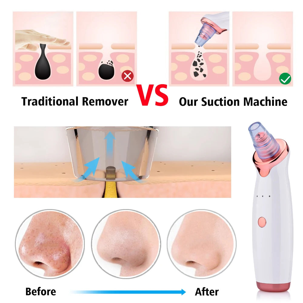 GlowLilly Electric Vacuum Blackhead Remover?